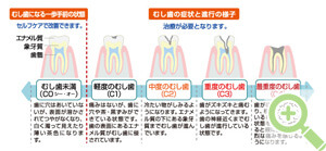 むし歯の進行