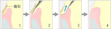 歯周ポケット掻把術
