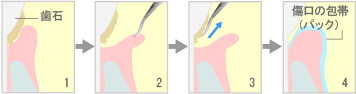 歯肉剥離掻把術