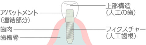 インプラントの構造
