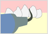 歯石・歯垢の除去